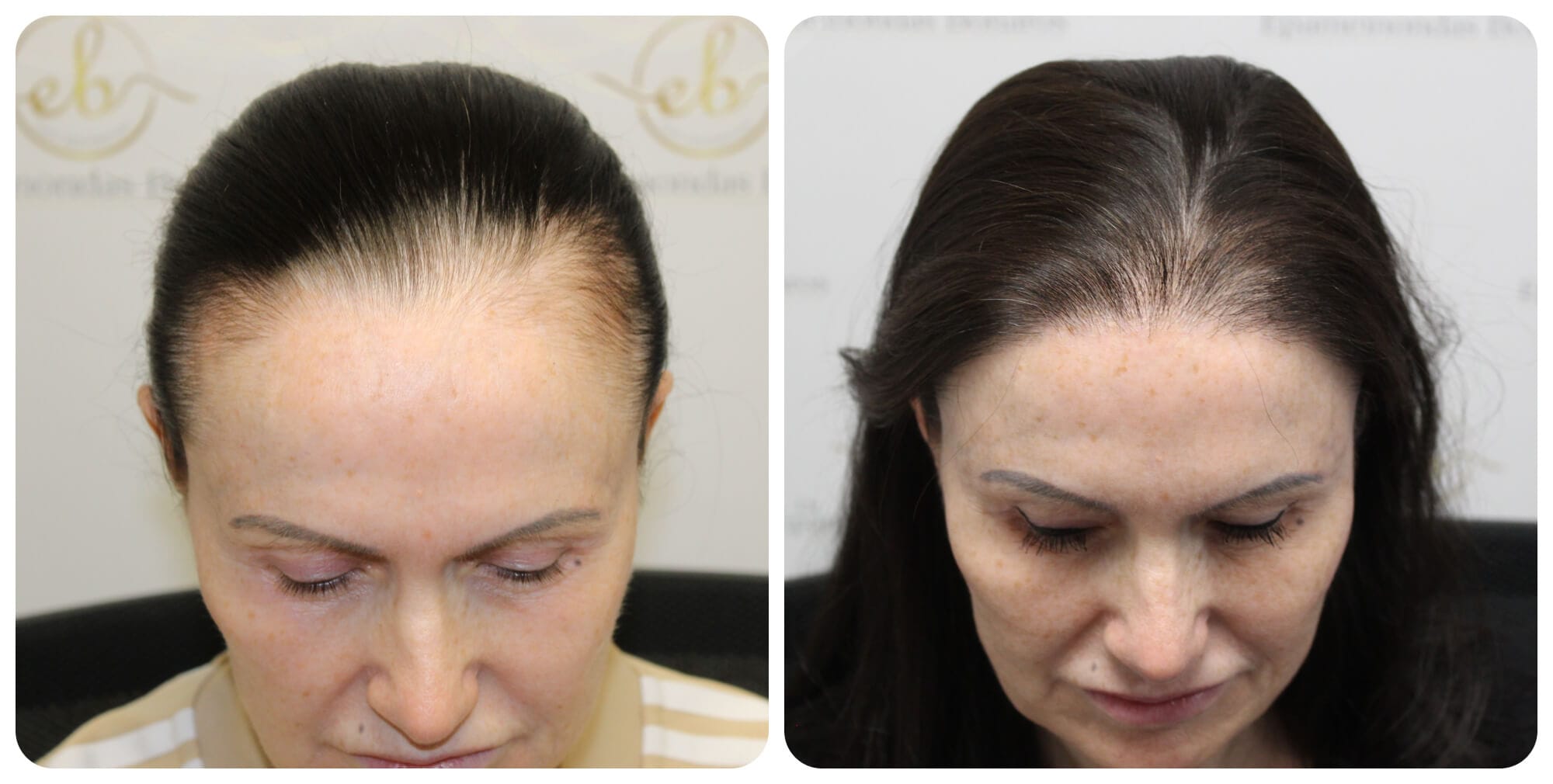 Private Hair Replacement Studio NYC for Men