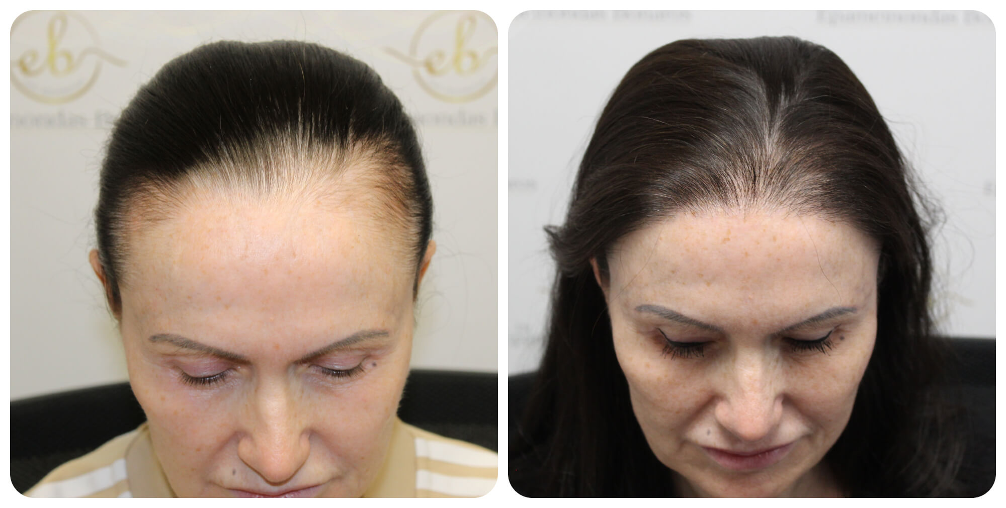 Private Hair Replacement Studio NYC for Men